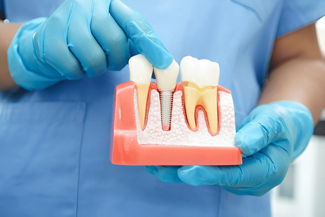 implant dentistry in burnaby bc