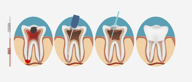 root canal treatment in burnaby bc
