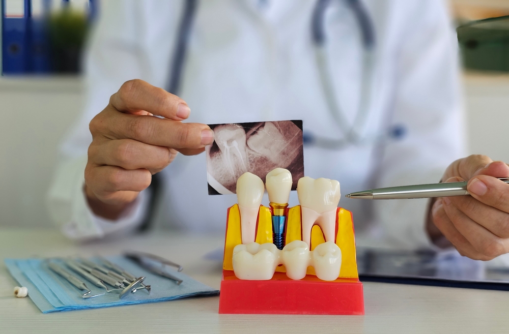 how long do dental implants last and how to care for them